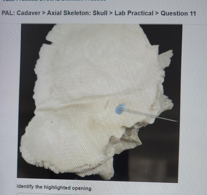 Vertebral cadaver axial cartilage outer